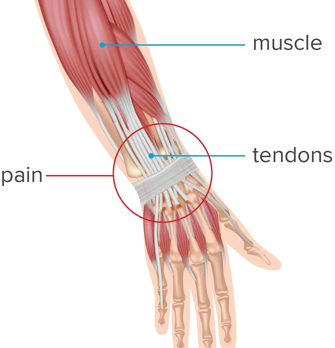 What to know about wrist tendonitis By Jenna Fletcher